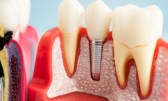 does sunbit cover dental implants
