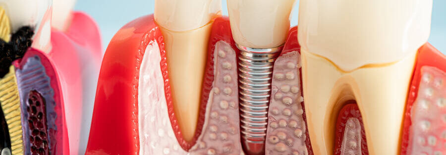 does sunbit cover dental implants
