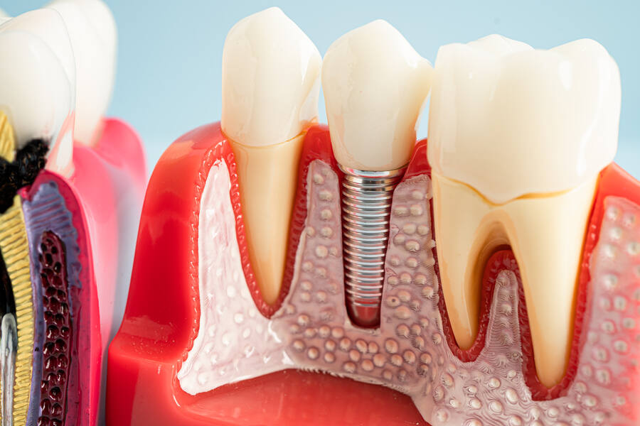does sunbit cover dental implants